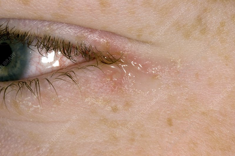 Eye Herpes Herpes Symptoms Causes Types Treatments Post Oak ER