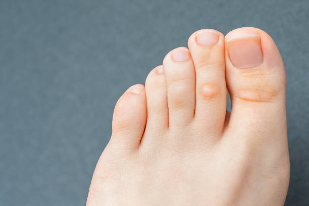 Get rid of corn on top of toe online