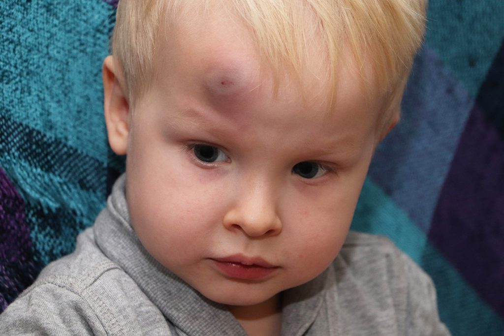 child head injury