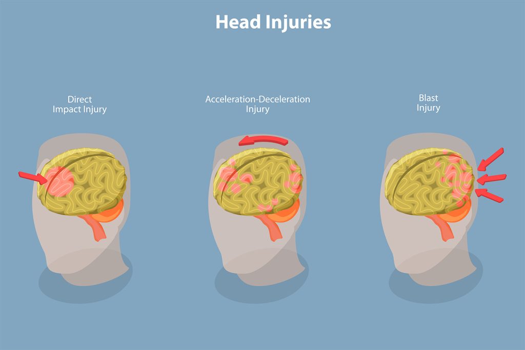 typs of head injuries