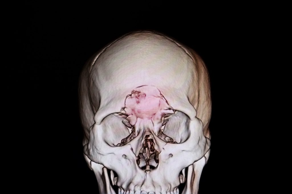 ct scan of a TBI