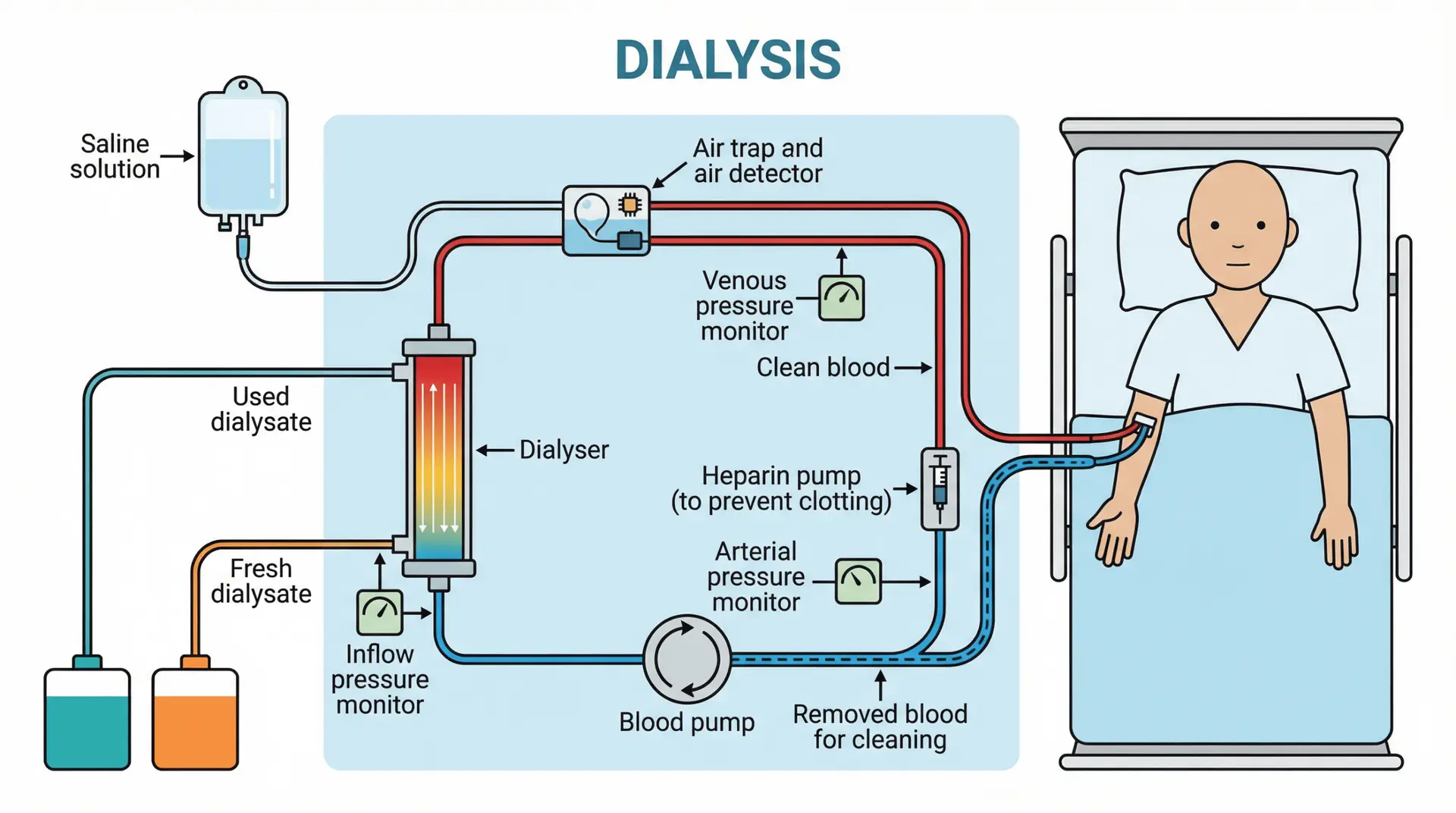 Diagram of hemodialysis showing blood flowing from a patient through a blood pump and dialyzer with fresh dialysate in and used dialysate out, plus safety components like an air trap, pressure monitors, and a heparin pump, before clean blood returns to the body.