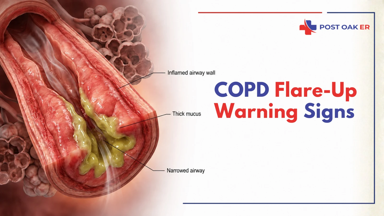 COPD flare-up warning signs infographic showing an inflamed airway wall, thick mucus, and a narrowed airway during a COPD exacerbation.