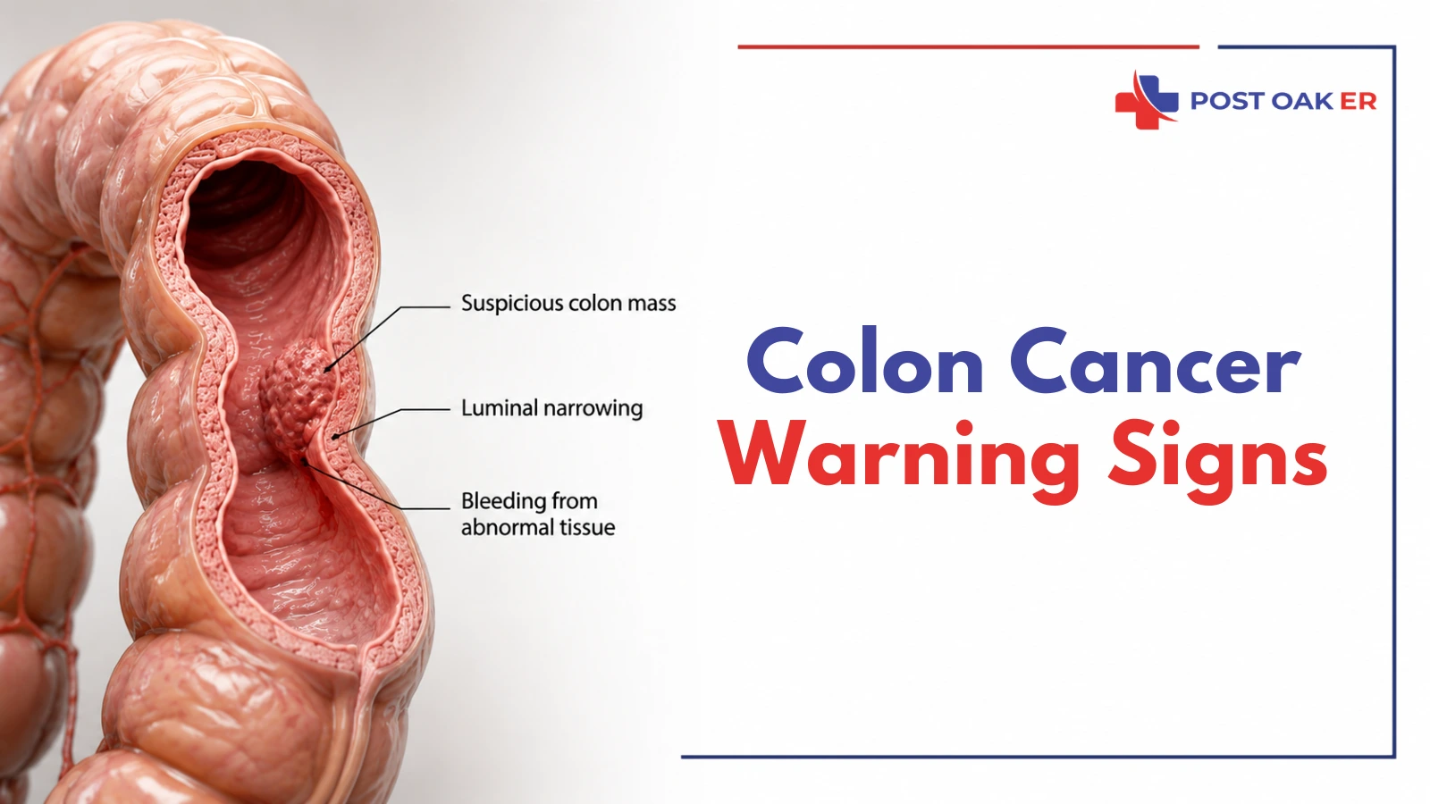 Colon cancer warning signs illustration showing a suspicious colon mass, luminal narrowing, and bleeding from abnormal tissue associated with blood in stool and bowel changes.