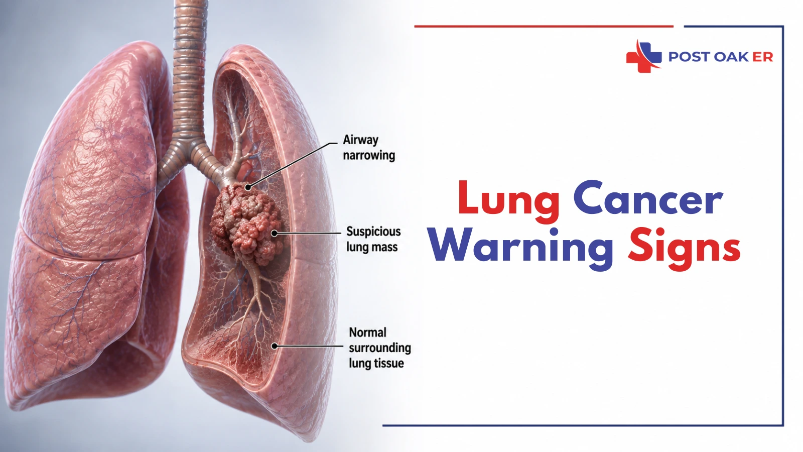 Lung cancer warning signs illustration showing a suspicious lung mass, airway narrowing, and surrounding lung tissue.