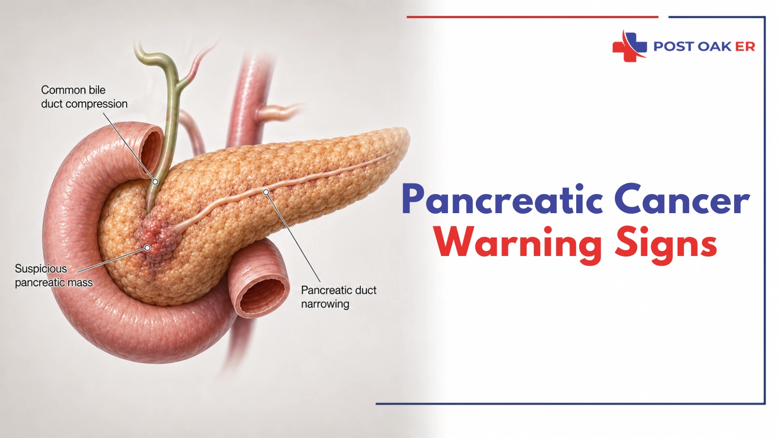 Pancreatic cancer warning signs illustrated with a labeled pancreas diagram showing a suspicious pancreatic mass, bile duct compression, and pancreatic duct narrowing, highlighting when abdominal or back pain needs evaluation.